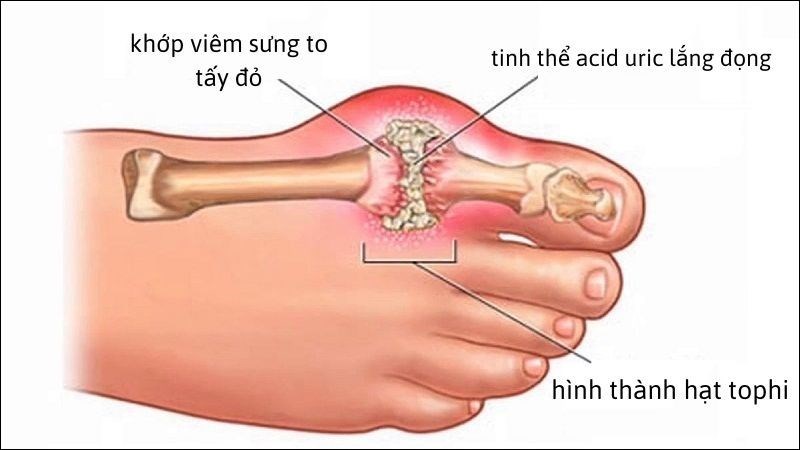 Bệnh Gout là gì?