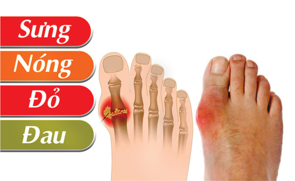 Bệnh Gout là gì?