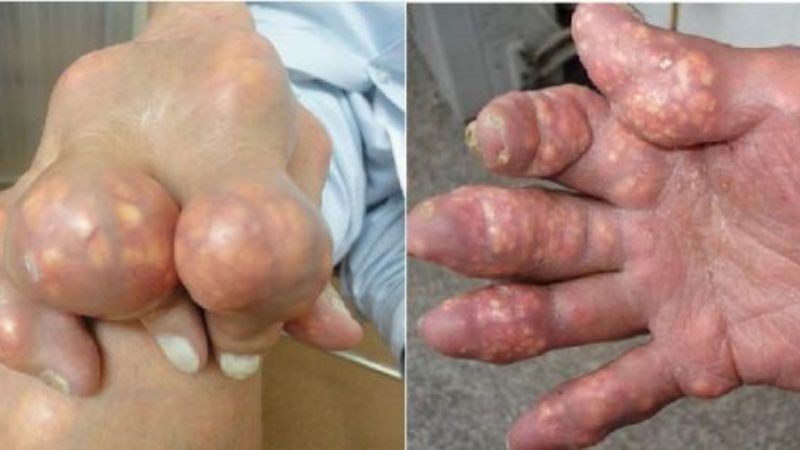 Bệnh Gout: Nguyên nhân, biểu hiện, cách điều trị mới nhất hiện nay