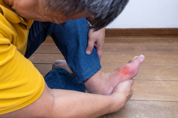 Bệnh gout đau gót chân là gì?