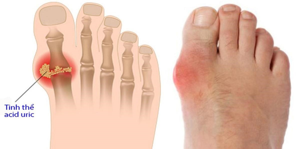 Bệnh gout đau gót chân là gì?