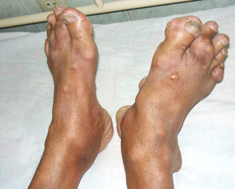 Bệnh gout đau gót chân là gì?