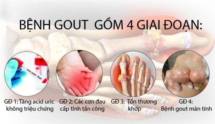 Bệnh gút có nguy hiểm không?