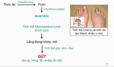 Biến chứng bệnh gout gây viêm thận