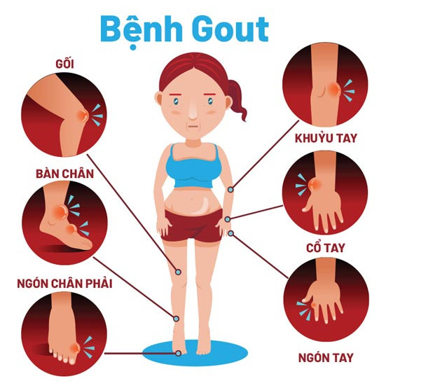 nguyên nhân gây bệnh gout