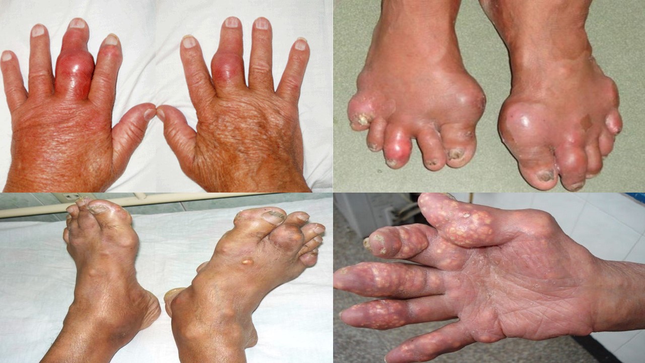 nguyên nhân gây bệnh gout