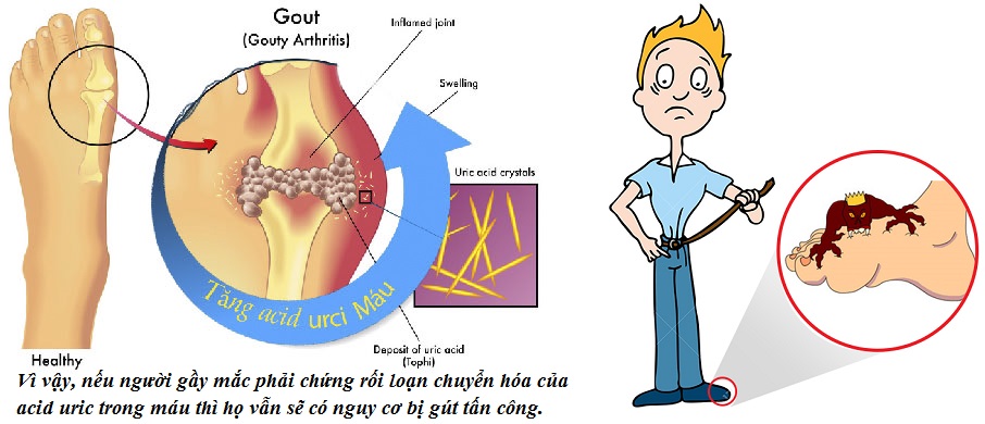 Người gầy có bị gút không? Câu trả lời của các chuyên gia