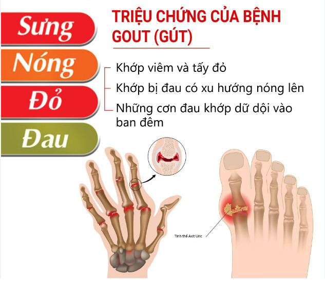 Bệnh gout ở nam giới