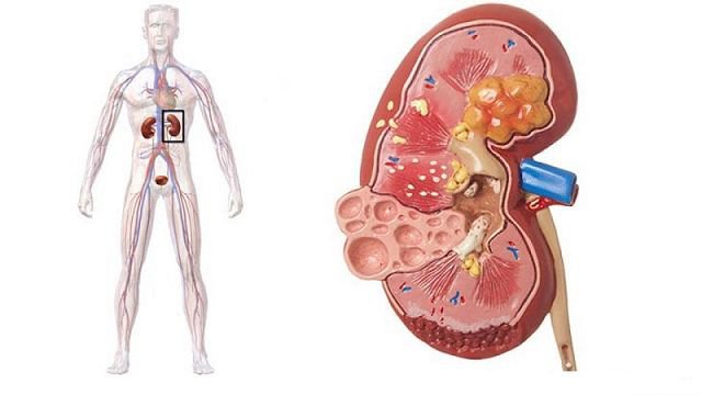 Bệnh gout ở nam giới