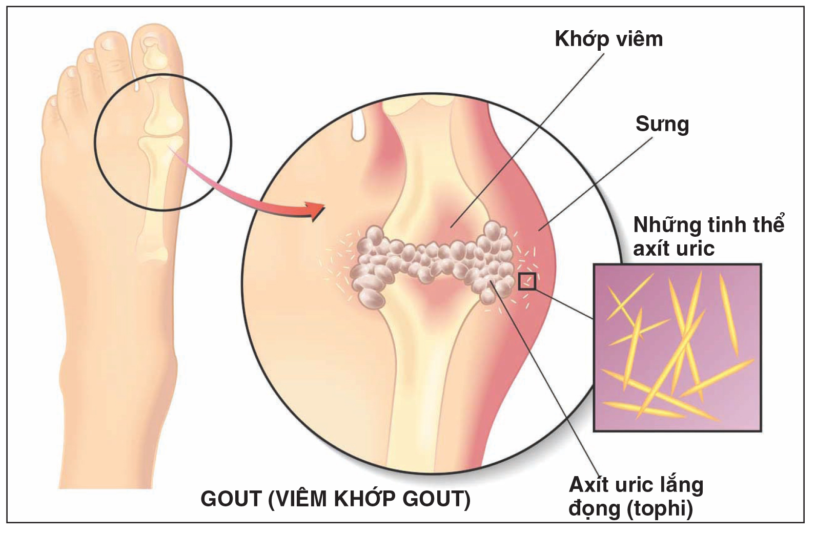 Phân biệt bệnh gút và viêm khớp dạng thấp