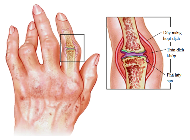 Phân biệt bệnh gút và viêm khớp dạng thấp