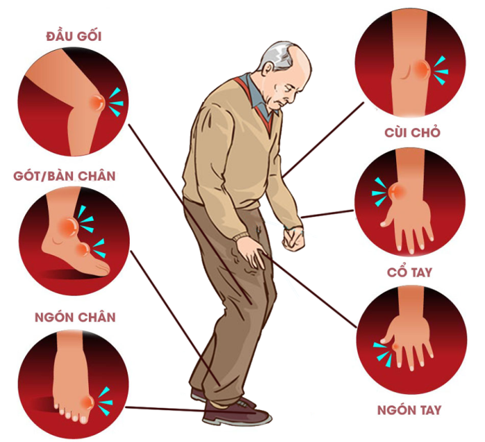 Phân biệt bệnh gút và viêm khớp dạng thấp