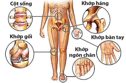 Phân biệt bệnh gút và viêm khớp dạng thấp: Những điều cần biết