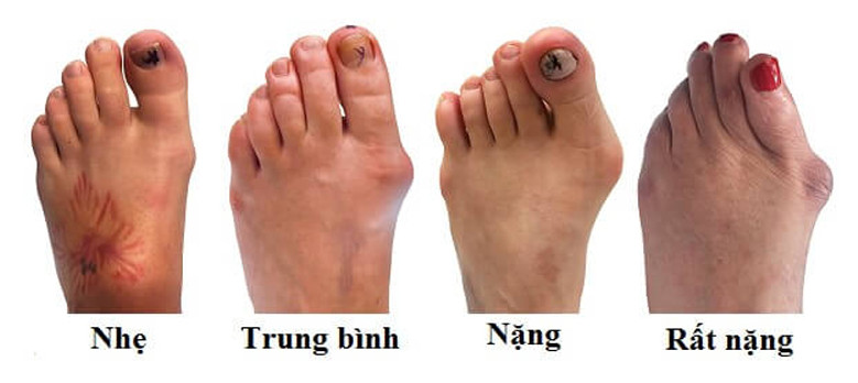 Các giai đoạn của bệnh gout