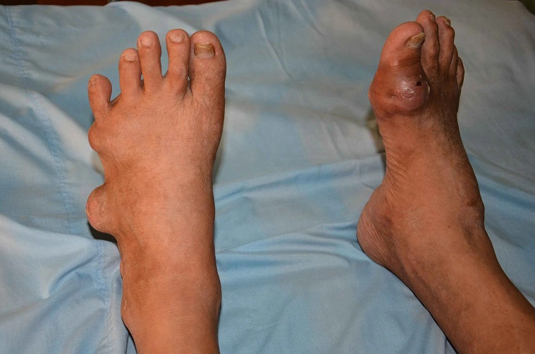 Bệnh gout ở nữ giới