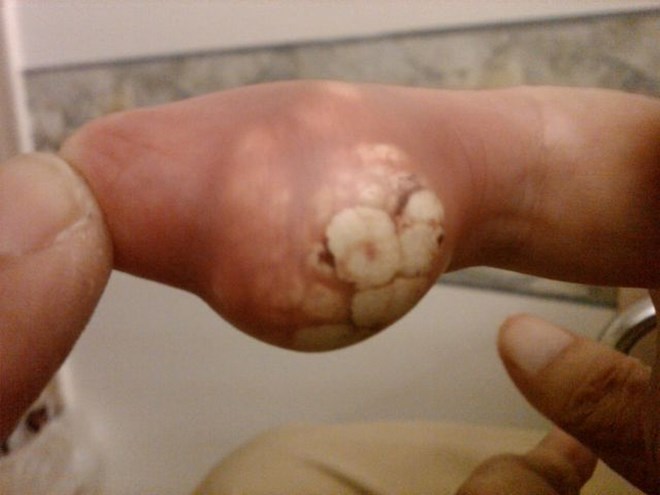 Bệnh gout ở nữ giới