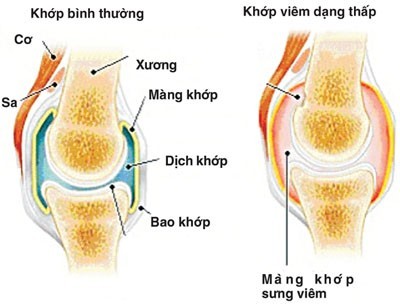 đau cổ chân có phải bị gút 