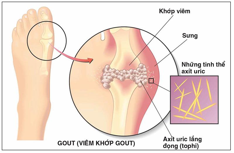 đau cổ chân có phải bị gút 