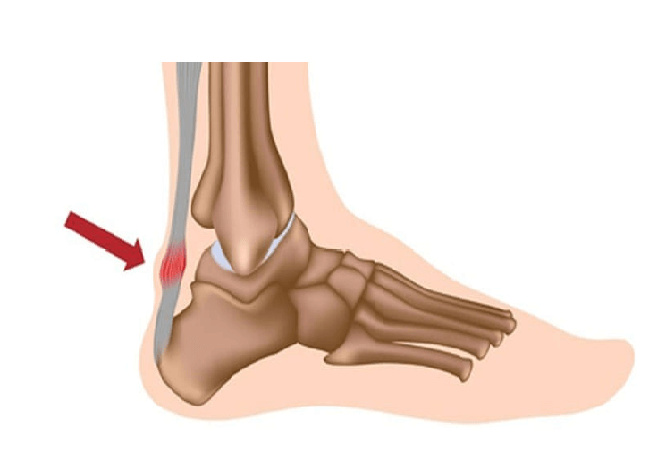 đau cổ chân có phải bị gút 