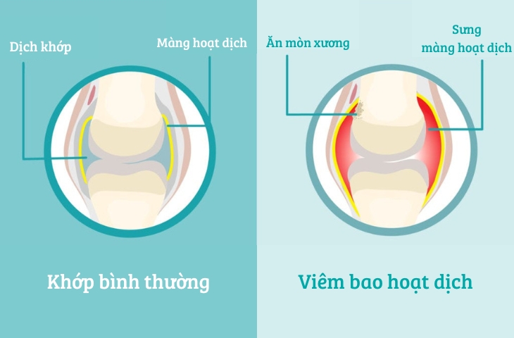 đau cổ chân có phải bị gút 