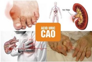 Tổng hợp nguyên nhân làm tăng acid uric máu và biến chứng nguy hiểm đến xương khớp, tim, thận