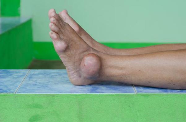 Bị gout sưng mắt cá chân