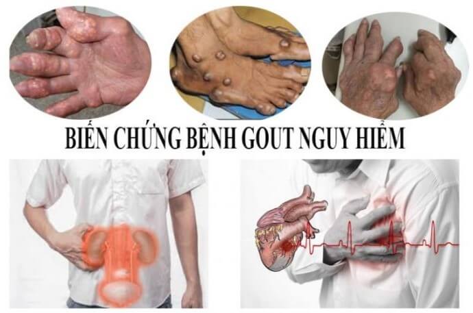 dấu hiệu bệnh gút ở tay