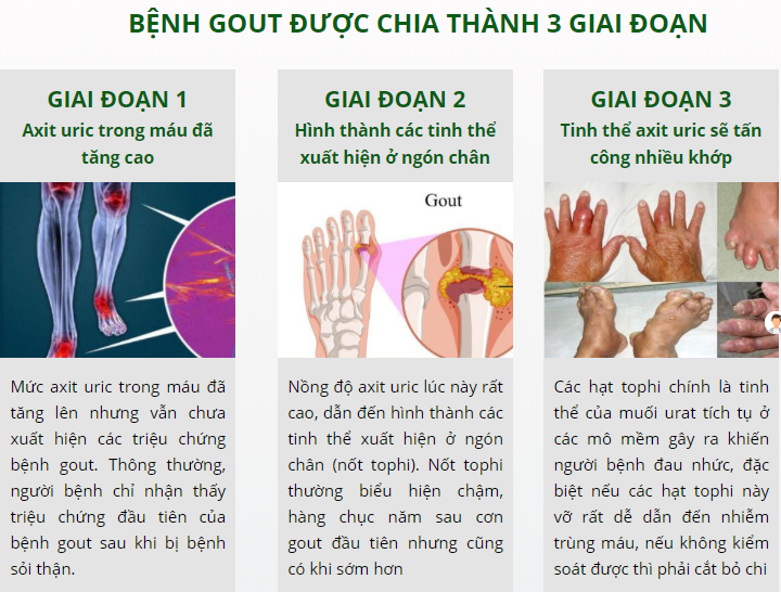 Dấu hiệu của bệnh gout và cách điều trị