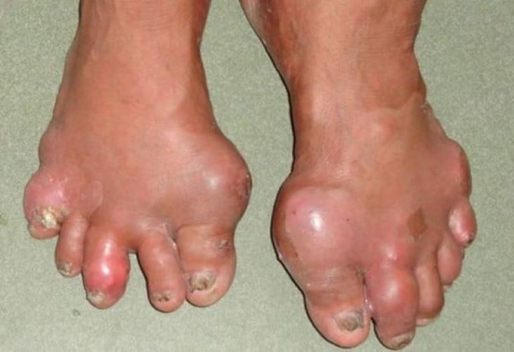 Dấu hiệu của bệnh gout và cách điều trị mới nhất hiện nay