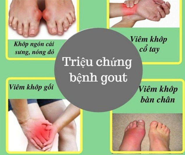 Dấu hiệu bệnh gout cấp