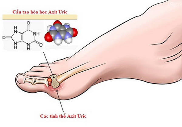 cách đào thải acid uric 