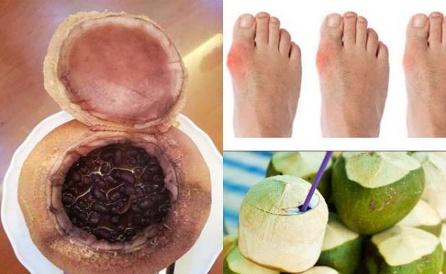 Top 10 cách điều trị bệnh gout tại nhà bằng cây thuốc nam