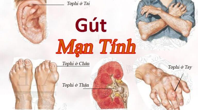 Cách điều trị bệnh gút mãn tính