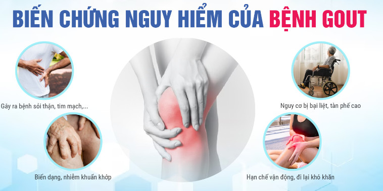 Bệnh gout gây biến dạng khớp