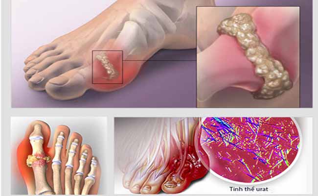 bệnh gout biến chứng suy thận