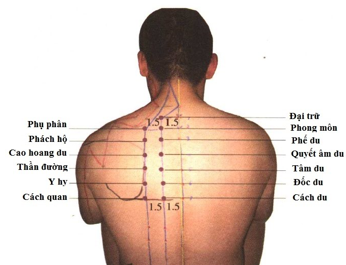 Điều trị gout bằng phương pháp châm cứu: Nên hay không nên?