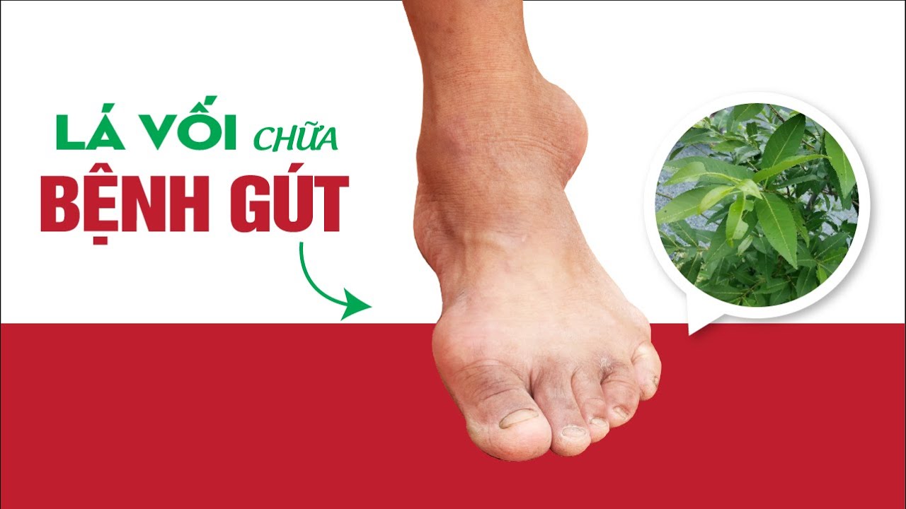 Chữa bệnh gút bằng lá vối