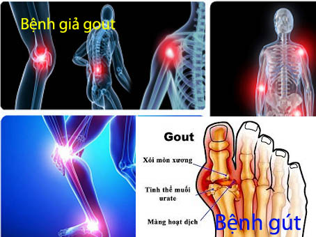 Phân biệt bệnh gout và giả gout: Nguyên nhân, triệu chứng, cách điều trị