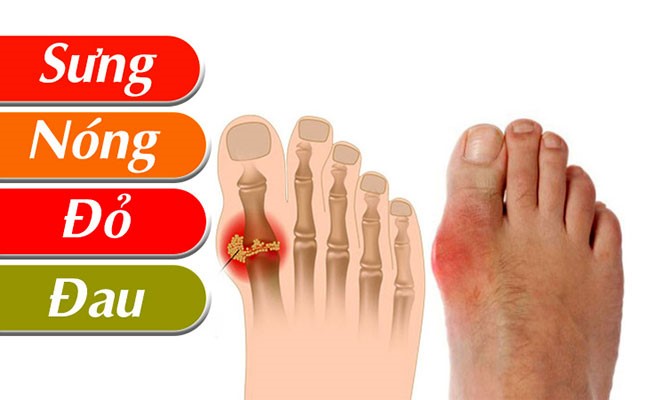 Phân biệt bệnh gout và giả gout