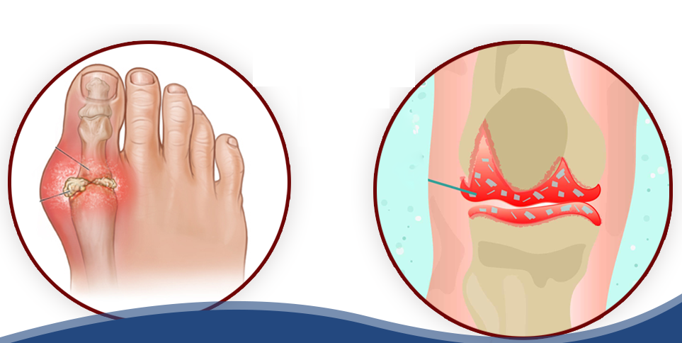 Phân biệt bệnh gout và giả gout