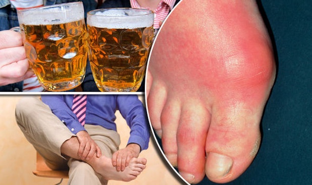 Bị gout có được uống bia được không?