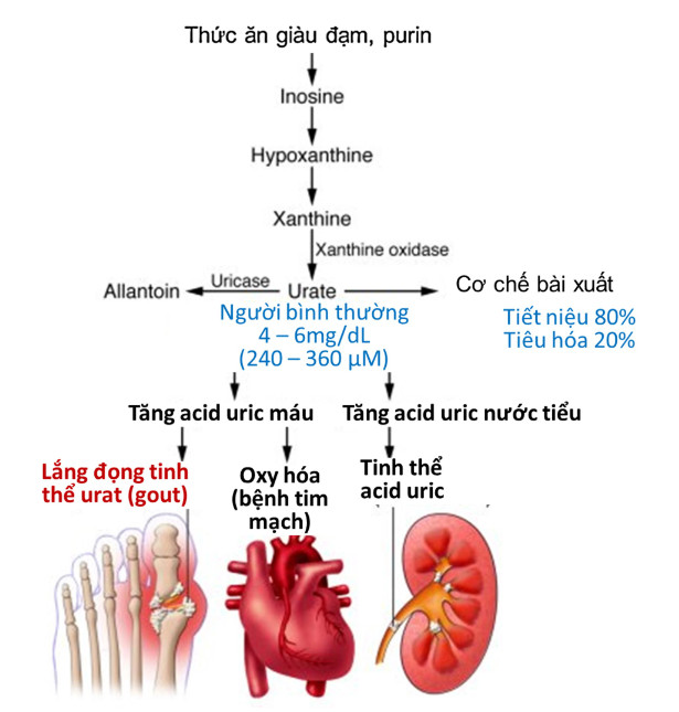 Bệnh gút gây sỏi thận