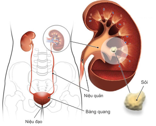 Bệnh gút gây suy giảm sinh lý