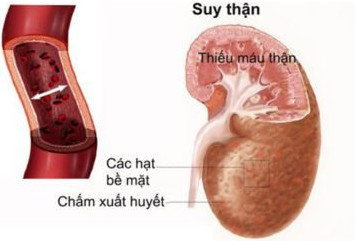 Bệnh gút và biến chứng thận