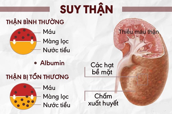 Bệnh gút và biến chứng thận