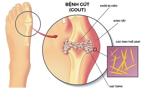 Tinh thể muối urat 