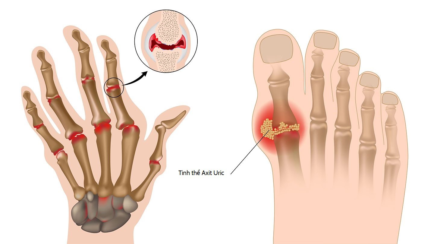 sai lầm khi điều trị gút