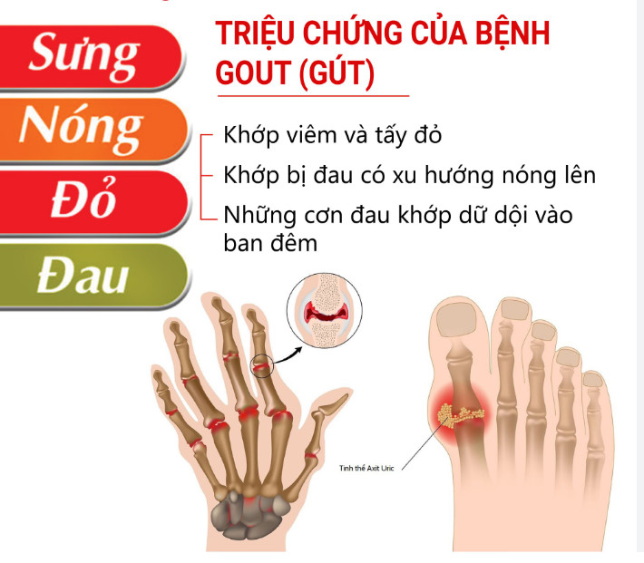 Bệnh gút ở người trẻ