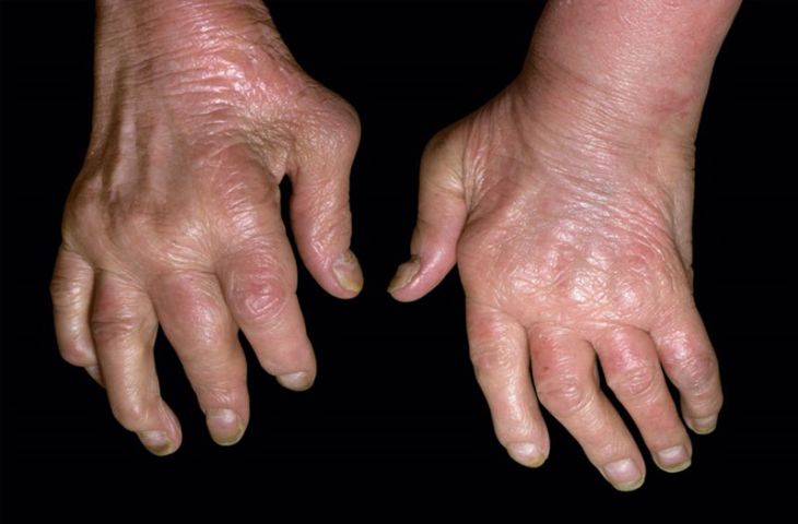 Bệnh Gout thống phong: Nguyên nhân và quan điểm điều trị theo Y học cổ truyền