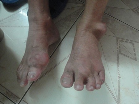 Vì sao bệnh gout thường gây đau vào ban đêm?